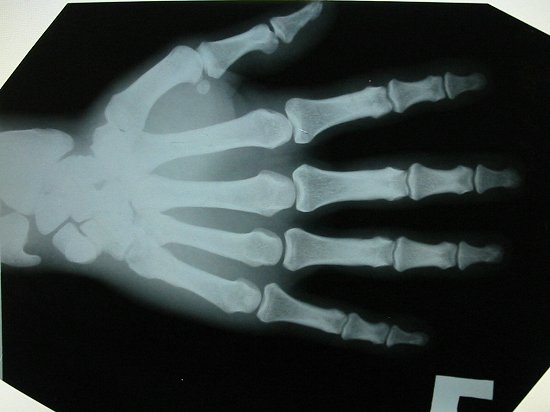 De Röntgenfoto van Ruslan's hand